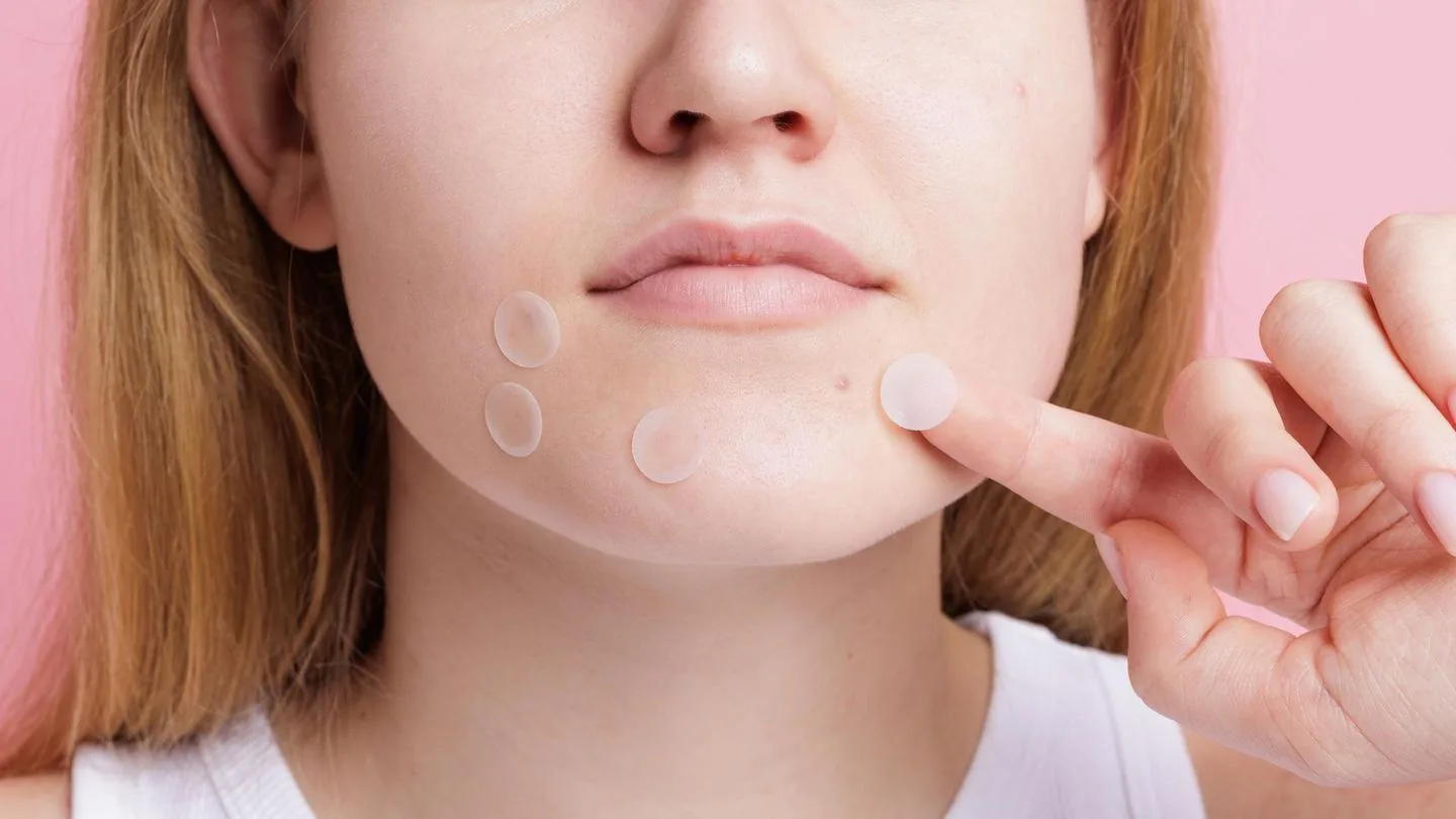 Beauty Secret: Do Pimple Patches Work Miracles?