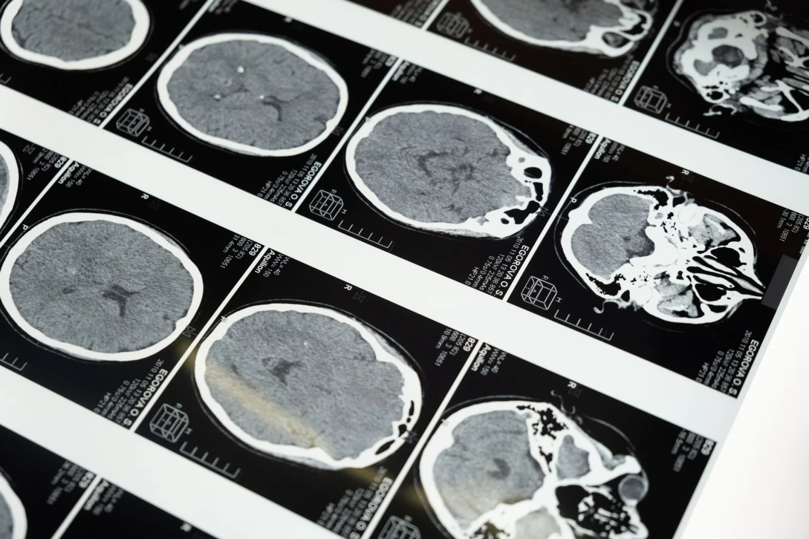 How Can We Prevent Dementia? Scientific Solutions from a Harvard Professor